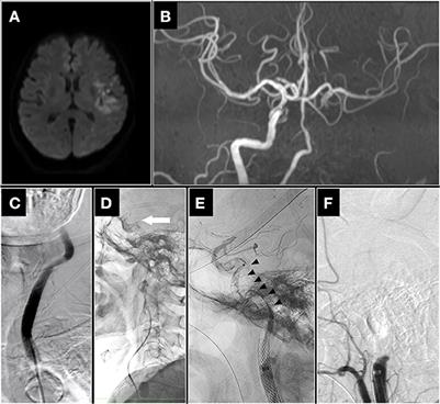 Parallel stent retriever mechanical thrombectomy of an acute internal carotid artery occlusion refractory to standard techniques: A case report